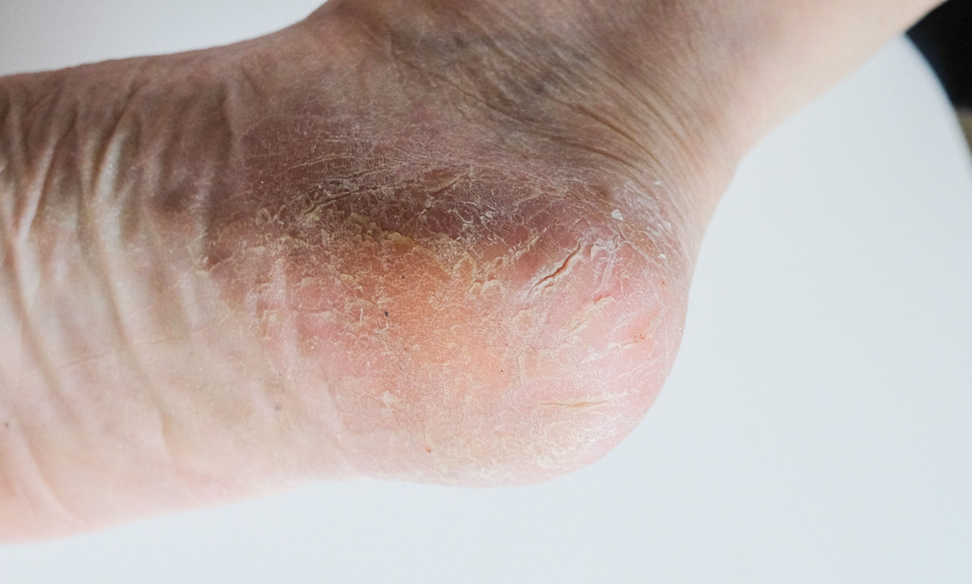 How to heal deep, cracked heels